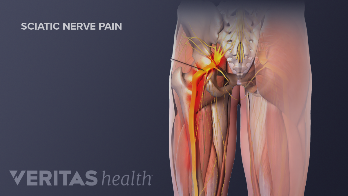 Patch forest Transistor Nerve Pain in the Leg