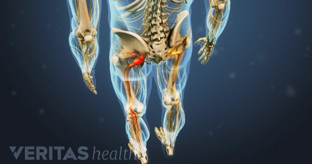 Lyrica (Pregabalin) for Back Pain