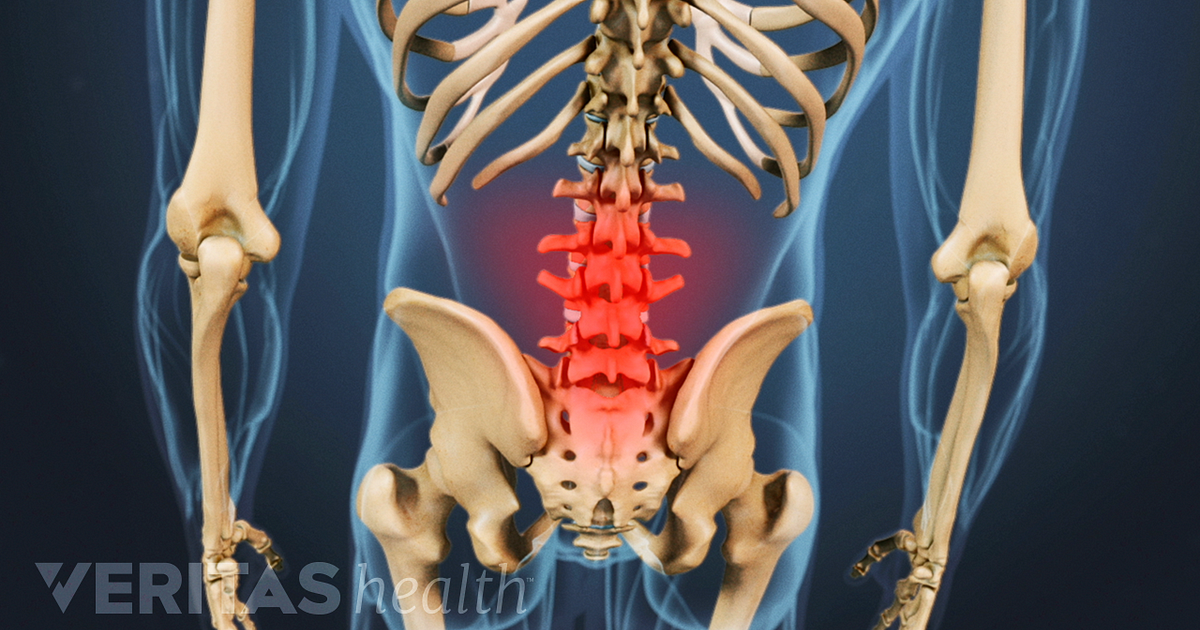what is arthritis of lower back