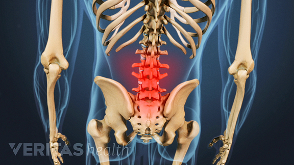 Lower Back Pain from Osteoarthritis