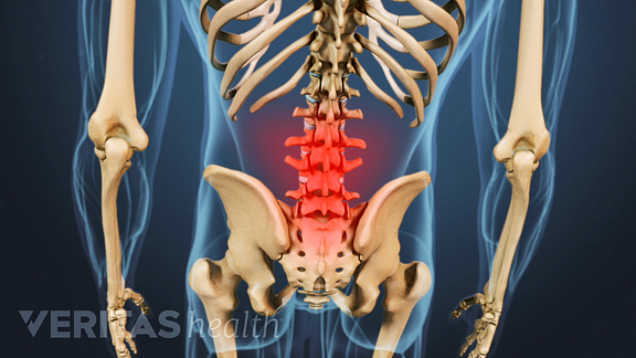 Medical illustration of the spine. The lumbar area is highlighted in red to indicate pain, numbness or tingling.