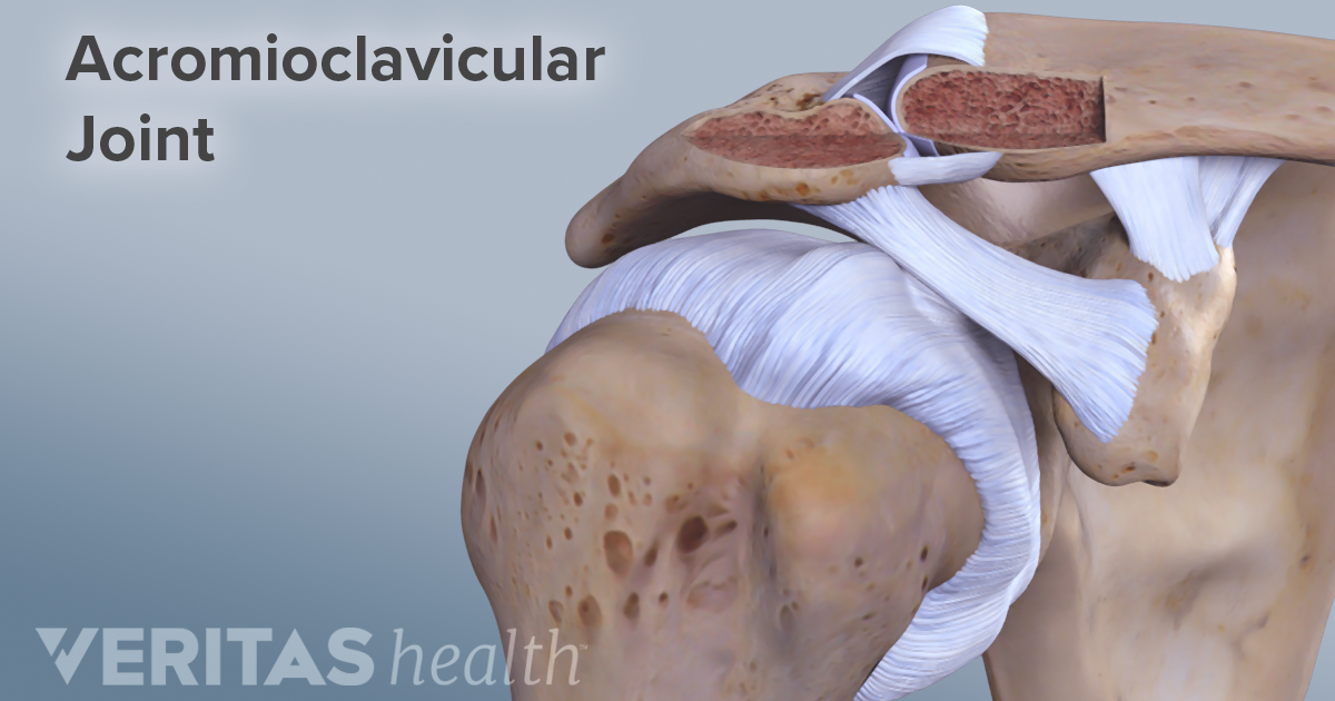 Acromioclavicular Osteoarthritis Causes