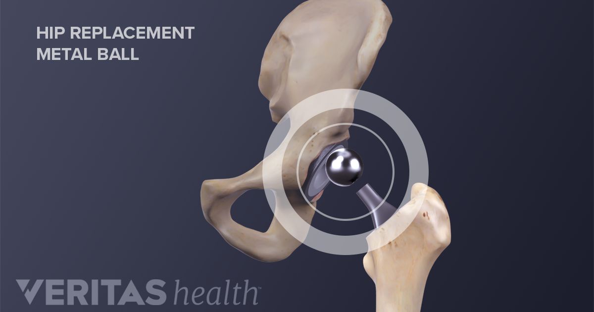 Minimally Invasive Total Hip Replacement