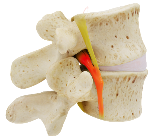 Diagram of vertebra with spinal stenosis before the Vertiflex Procedure.