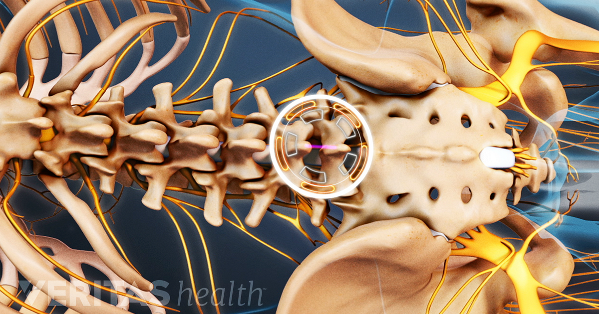 Orthopedic Surgeon vs. Neurosurgeon for Spine Surgery