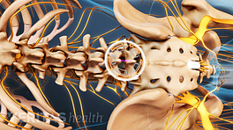Posterior view of the lumbar spine and pelvis highlighting the microdiscectomy location.