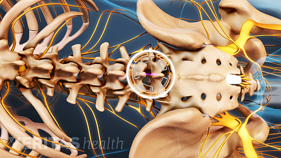 Lumbar Microdiscectomy Surgery Video