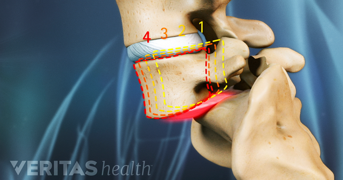 i spondylolithesis In this article i discuss some key information you should understand when learning what spondylolisthesis exercises to avoid. i spondylolithesis In this article i discuss some key information you should understand when learning what spondylolisthesis exercises to avoid.