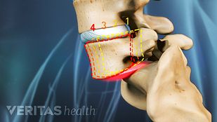 El termino espondilolistesis