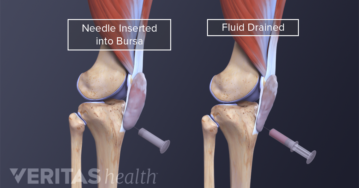 knee bursitis térdízület patella sérülés