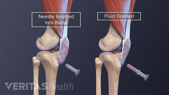 Prepatellar Bursitis Treatment