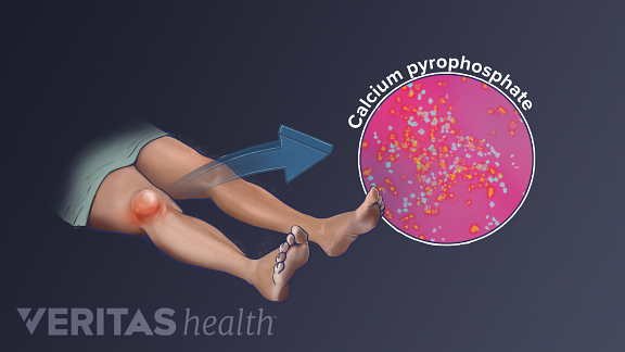 Ilustración de la inflamación de la rodilla por la pseudogota causada por el pirofosfato cálcico