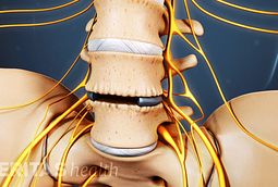 Surgery for Lumbar Degenerative Disc Disease