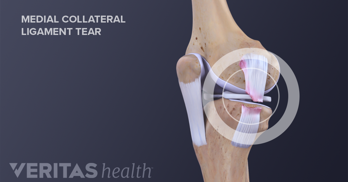 Treatment Options and Recovery for MCL Sprains and Tears