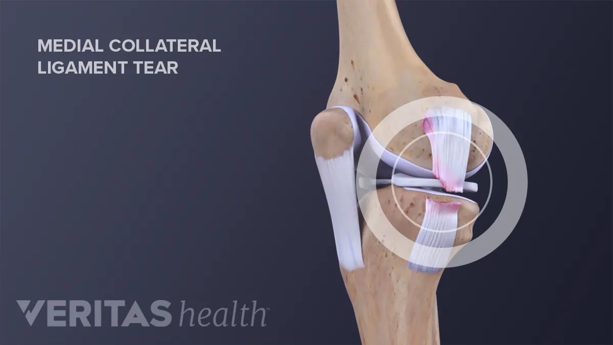 Medial Collateral Ligament (MCL) Tears and Sprains