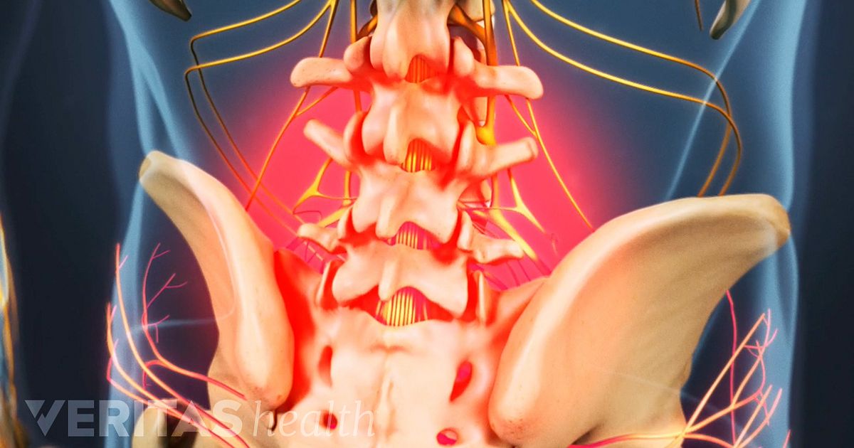 3 Symptoms That May Indicate You Have Lumbar Degenerative ...