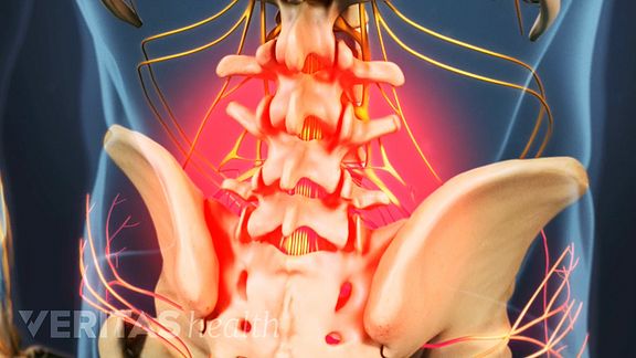 Pain from lumbar degenerative disc disease is usually tolerable. It is normally felt in the lower back, but can radiate into the hips and legs.