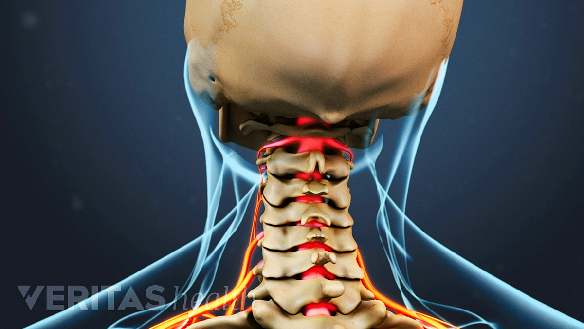 Cervical Radiculopathy From A Herniated Cervical Disc