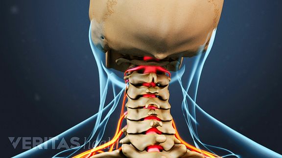 Cervical Spinal Stenosis Video