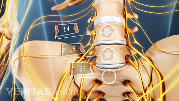 Our Sciatica Video Helps You Visualize the Pain