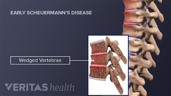 Wedged Vertebrae Early Scheuermann's Disease