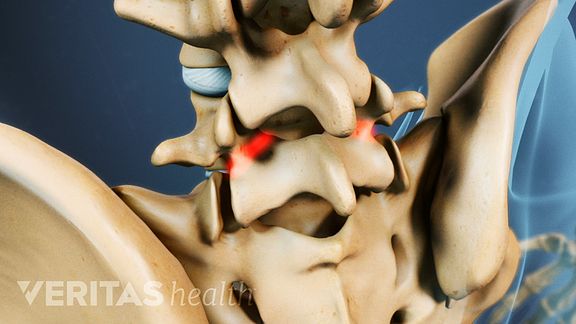 Understanding Isthmic Spondylolisthesis