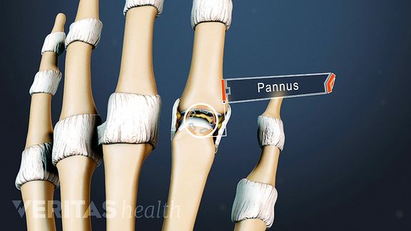 What Is Pannus?