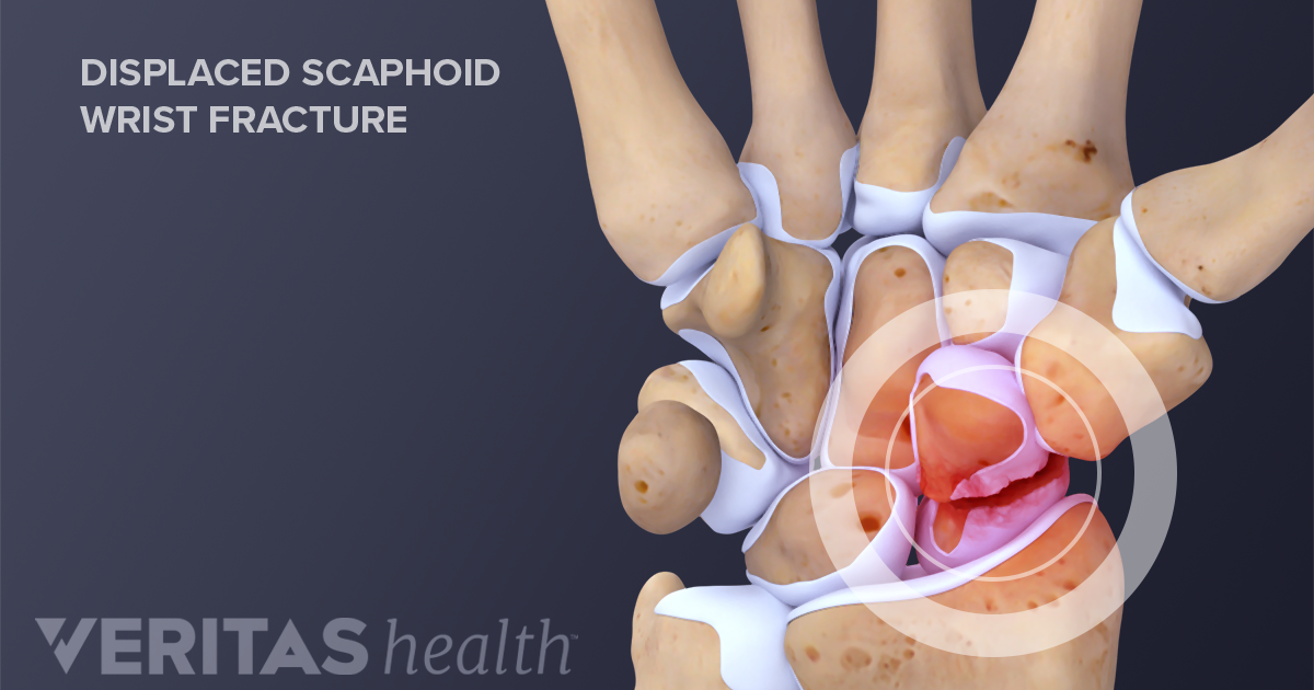 scaphoid-fracture-and-other-types-of-wrist-fractures