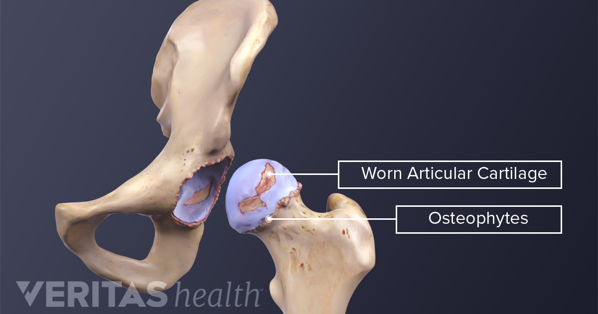 Mi okozhat vállfájdalmat? - A vállízületi arthrosisról