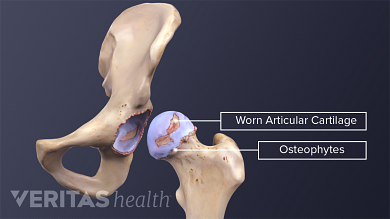 a térd osteoarthritis 3