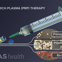 Platelet-rich plasma therapy showing the combination of platelet poor plasma, platelet rich plasma, and red blood cells.