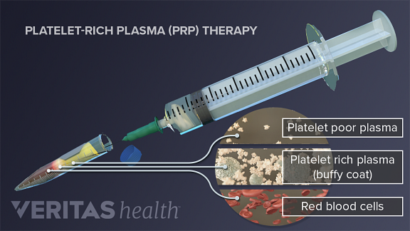 Platelet-rich plasma therapy showing the combination of platelet poor plasma, platelet rich plasma, and red blood cells.