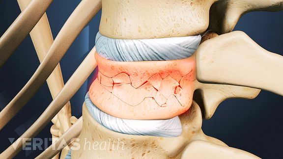 Causes of Upper Back Pain