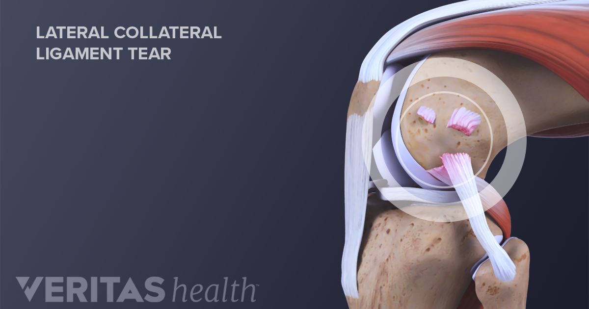 Diagnosing Lateral Collateral Ligament (LCL) Tears