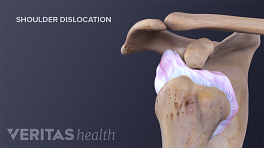 Anterior view of a dislocated shoulder