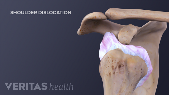 3 Risk Factors For Shoulder Dislocations