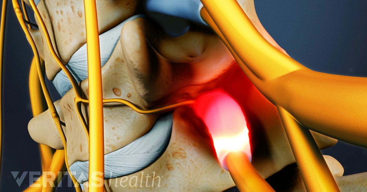 Spinal Stenosis Symptoms and Diagnosis