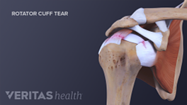 Anterior view of the shoulder joint showing the rotator cuff tear.