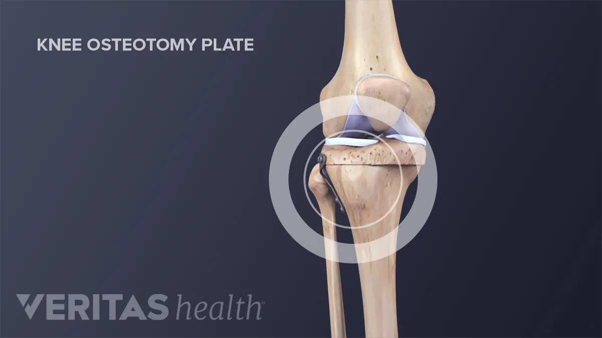 Knee Osteotomy Surgery