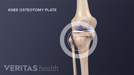 Medical illustration showing the cuts in the tibia as part of a tibial osteotomy surgery