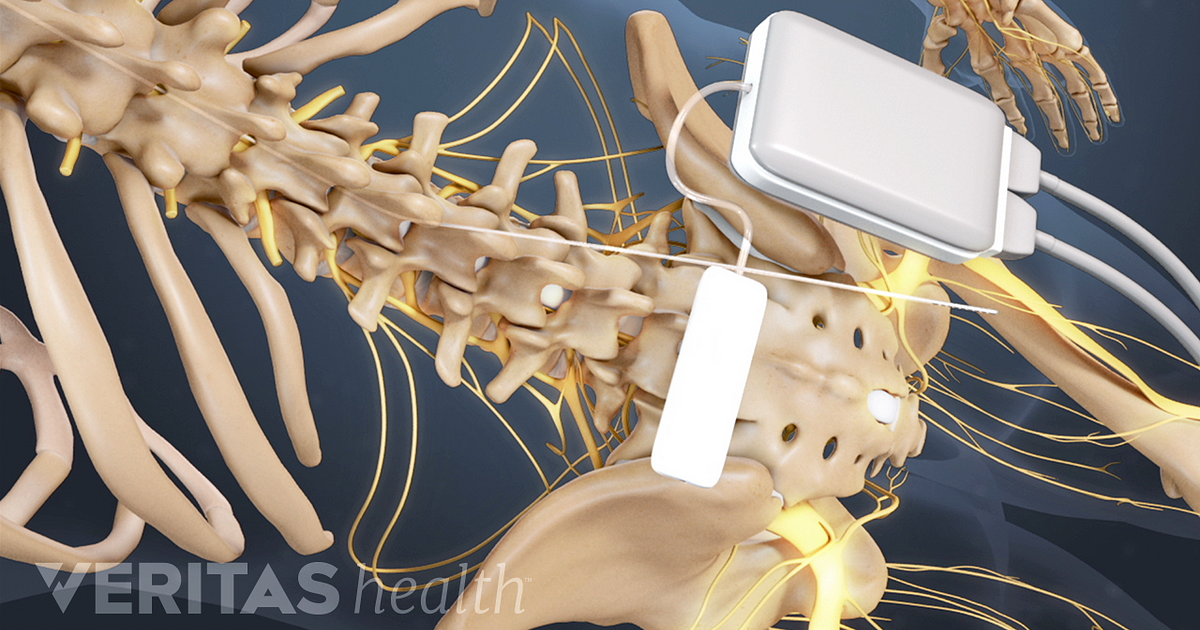 spinal cord dorsal column stimulator