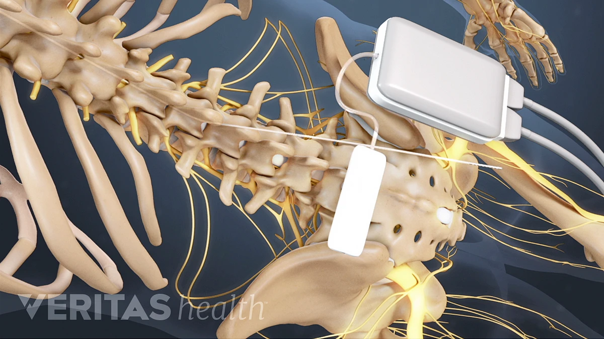 Spinal Cord Stimulation in NYC  Sports Injury & Pain Management