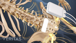 Implantation of spinal cord stimulator for lower back pain
