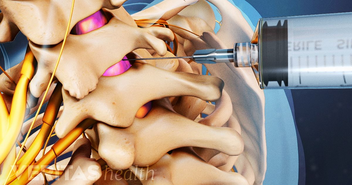 Cervical Epidural Steroid Injection Video