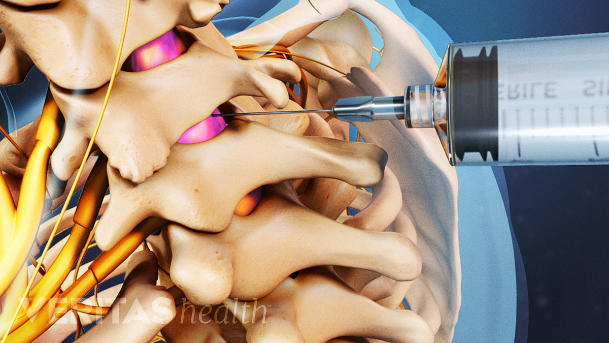 Cervical Epidural Steroid Injections Can Bring Neck And Arm Pain Relief