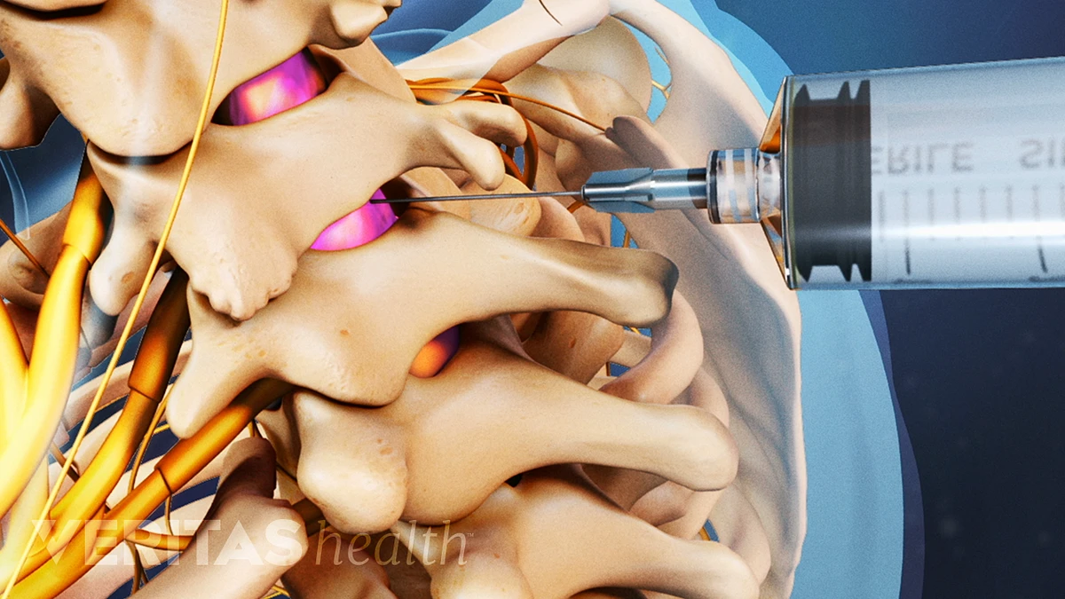 Epidural Steroid Injection Pain Relief Success Rates