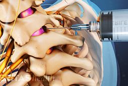 Epidural steroid injection success rates