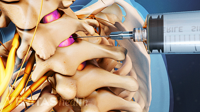 How Long Should You Rest After Epidural Steroid Injection How Long Should You Rest After Epidural Steroid Injection
