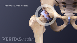 gerinc osteoarthritis)