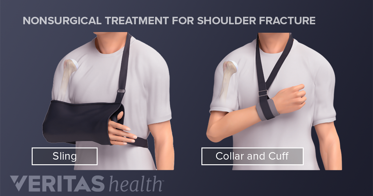 Treating A Clavicle Fracture